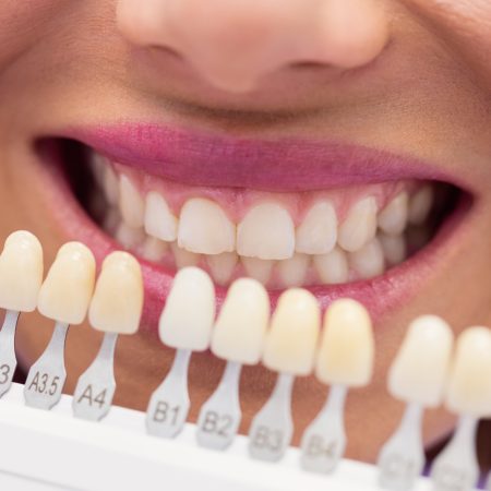 Blanqueamiento dental