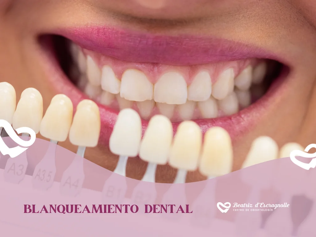 Blanqueamiento dental