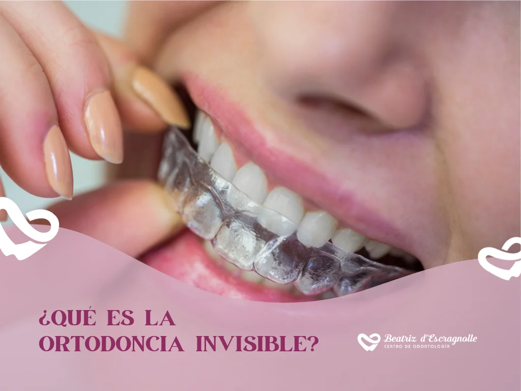 ¿Qué es la ortodoncia invisible?