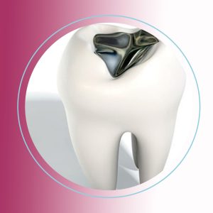 01-Extracción-amalgamas-tratada