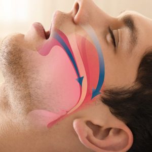01-apnea 01-apnea